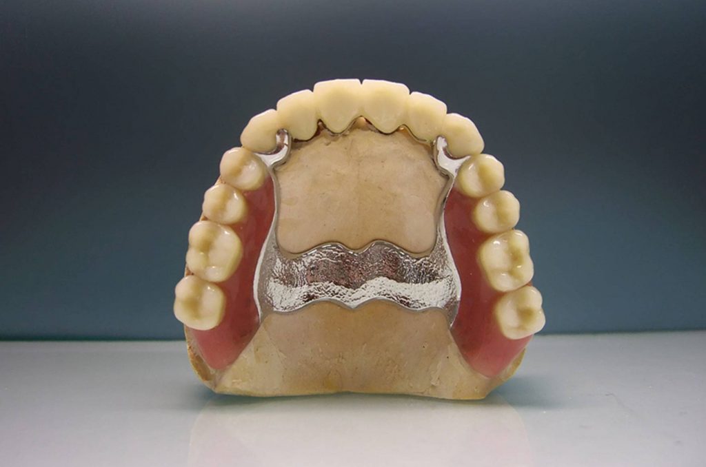 Бюгельный протез зубов